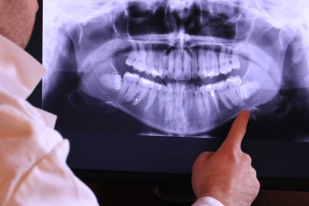 Best Emergency Wisdom Teeth Removal in Winterville, GA